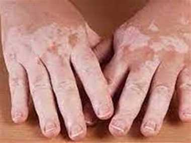 Sparsh Leprosy Awareness Campaign : 13 फरवरी तक जागरूकता रथ द्वारा गांव गांव में भ्रमण कर ग्रामीणों को किया जाएगा जागरूक